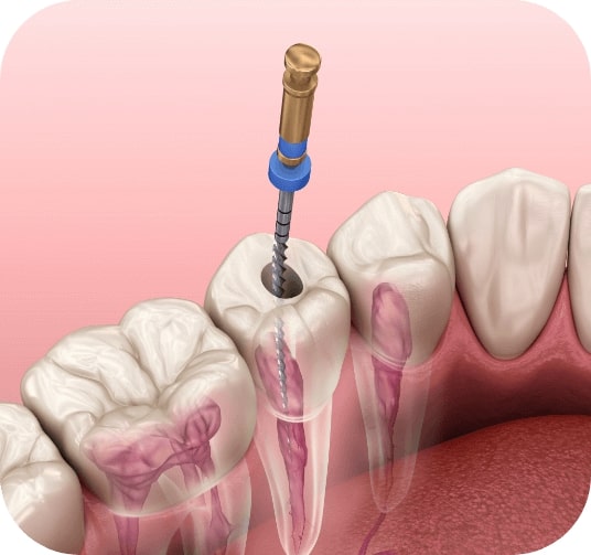 Animated smile during root canal treatment