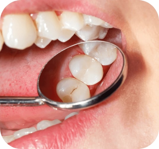 Closeup of smile with dental sealants