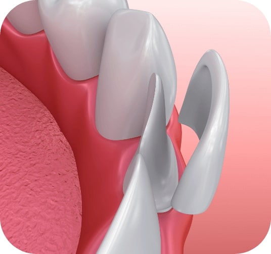 Animated smile during veneers placement