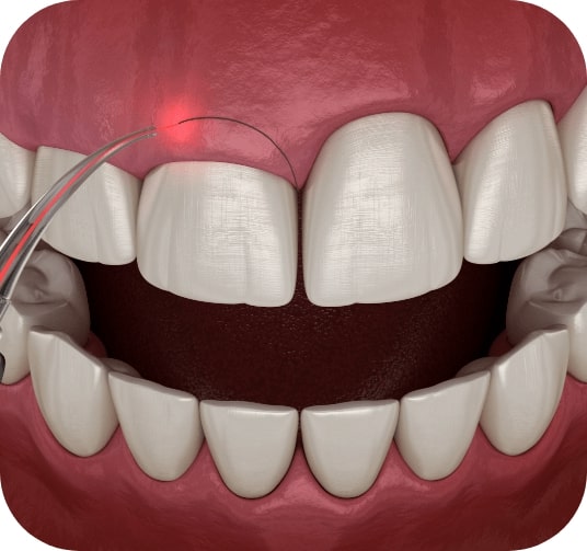 Animated smile during gum recontouring