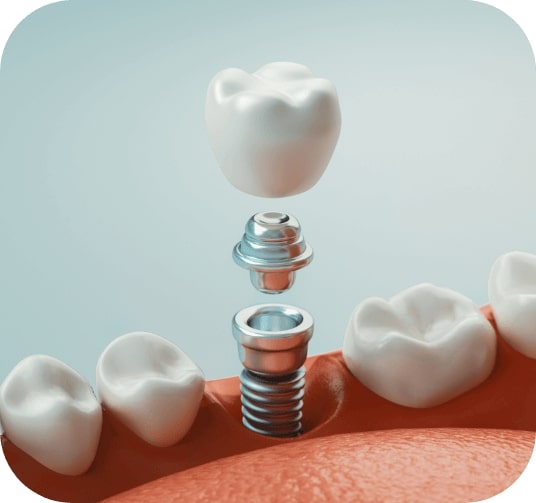 Animated smile during dental implant supported dental crown placement