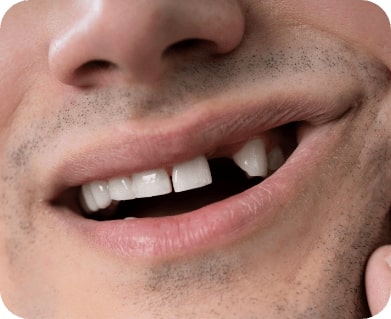 Closeup of smile with individual missing tooth
