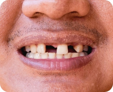 Closeup of smile with multiple missing teeth