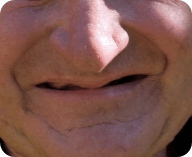 Closeup of smile missing all teeth